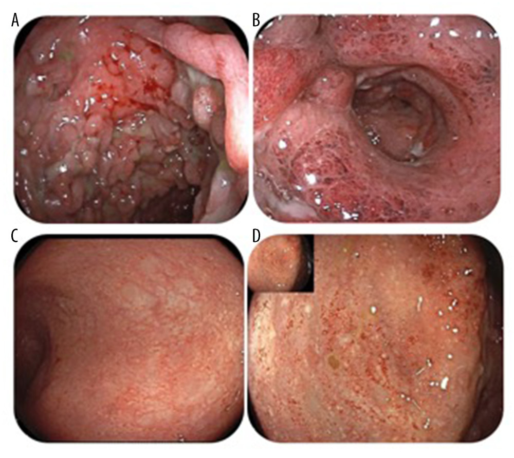 (A) The rectum before starting upadacitinib, with severe ulcerations, loss of vascularity, pseudopolyps, and deformed lumen. (B) The sigmoid colon before starting upadacitinib, with severe ulcerations, loss of vascularity, pseudopolyps,and deformed lumen. (C) The rectum after 6 months of upadacitinib, with no ulcerations except for mild erythema. (D) The sigmoid after 6 months of upadacitinib, with no ulcerations.