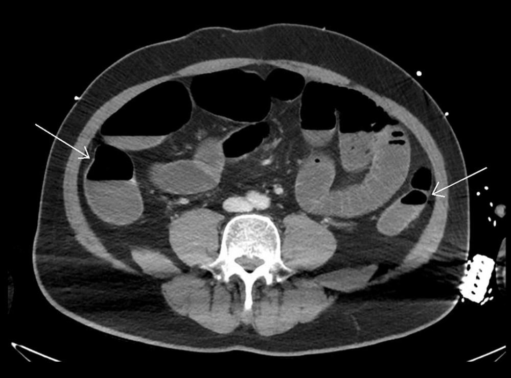 Abdominal computed tomography angiography showing small and large bowel dilatation, with fluid and gas levels throughout (large bowel indicated with arrows).