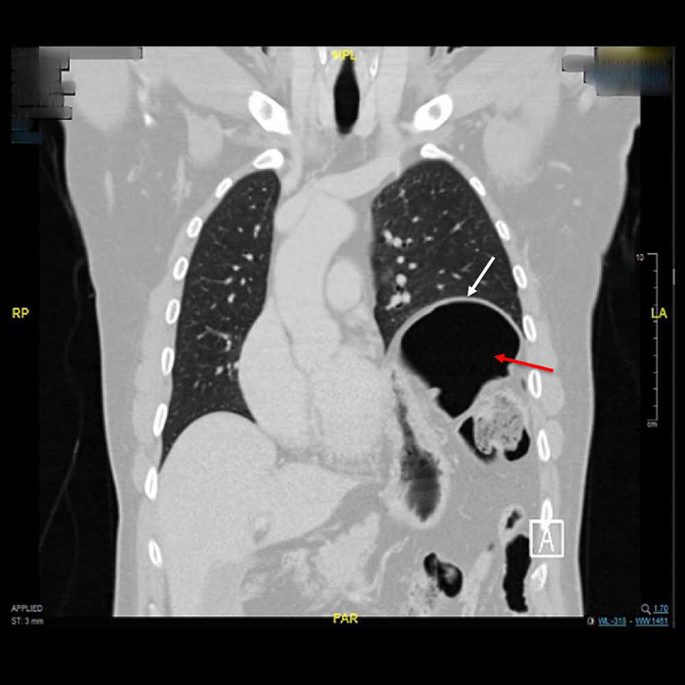 Computed tomography (CT) scan of the chest (coronal view) showing the left intact hemidiaphragm is markedly elevated (white arrow) together with distended segments of the colon (red arrow).
