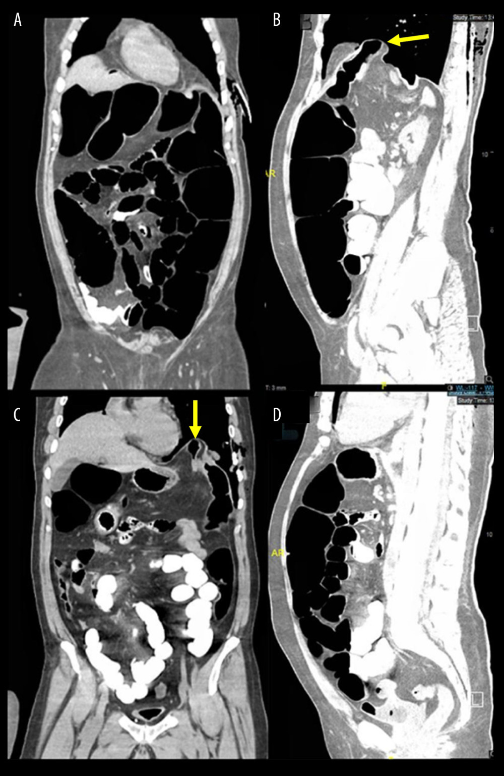 Abdominal computed tomography (CT) scan with contrast sagittal (B, D) and coronal views (A, C) showing dilation of the whole colon with a reduction in the caliber of the splenic flexure, which is interposed in the diaphragm (yellow arrows)
