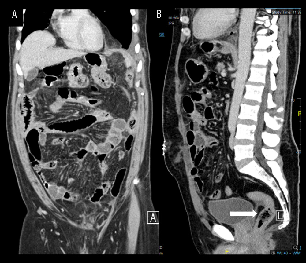 Abdominal computed tomography (CT) scan with contrast coronal (A) and sagittal (B) views showing normal bowel without dilation, and the rectum is not collapsed (white arrow).