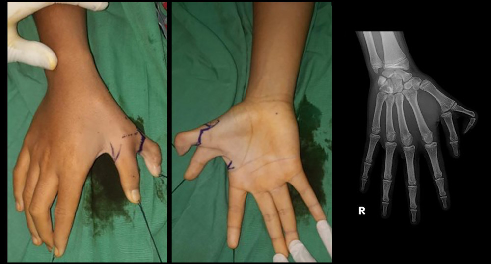 Pre-operative physical status and radiograph of a 13-years-old Asian boy with preaxial polydactyly Wassel type IV of the right hand.