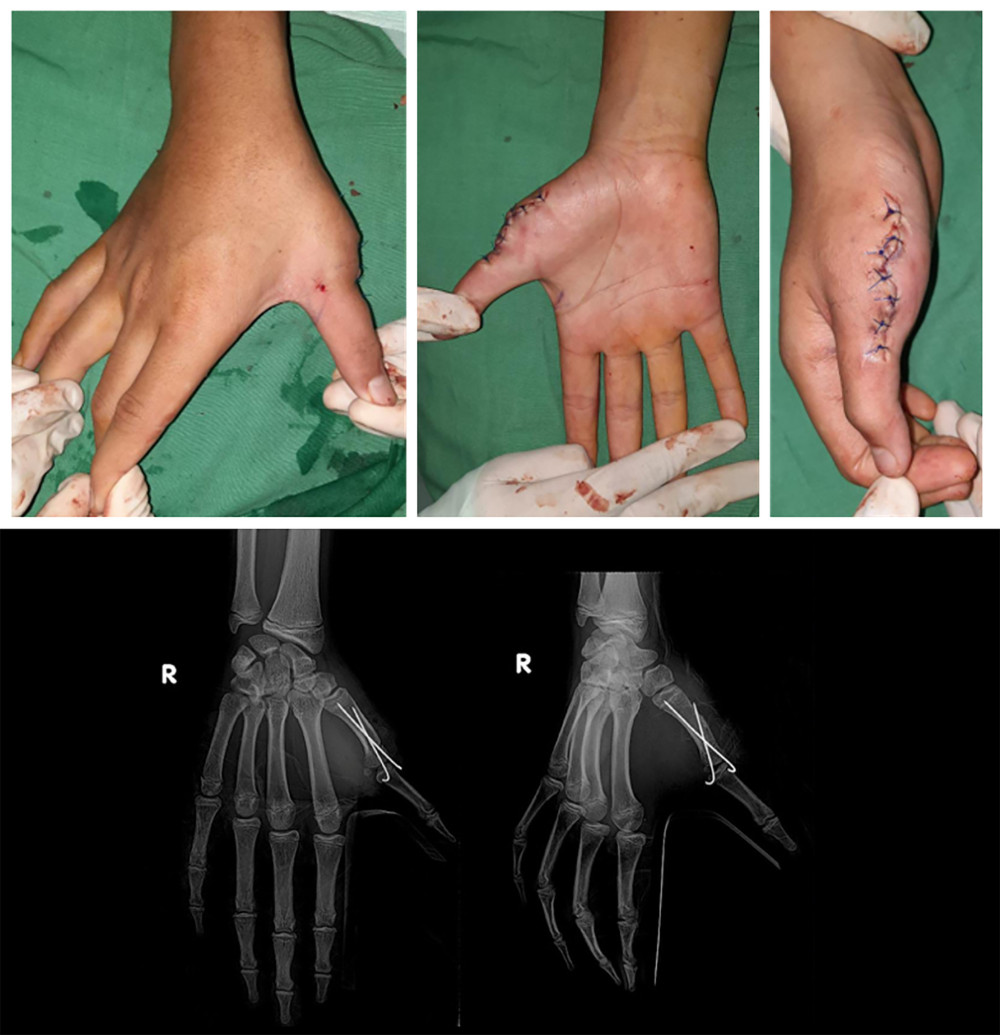 Postoperative physical status and radiograph after we reconstructed the radial collateral ligament and performed the first metacarpal osteotomy, then fixated it with 1.6-mm crossed Kirschner wire.