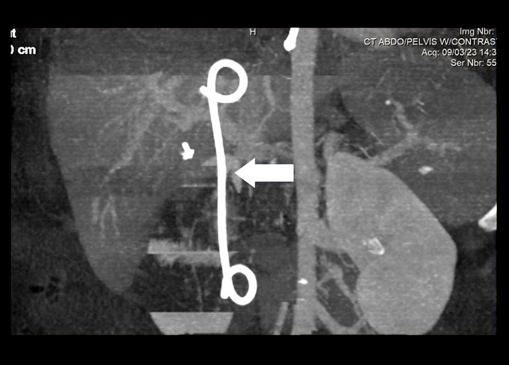 Computed tomography (CT) imaging demonstrating the biliary pigtail stent in place (white arrow).