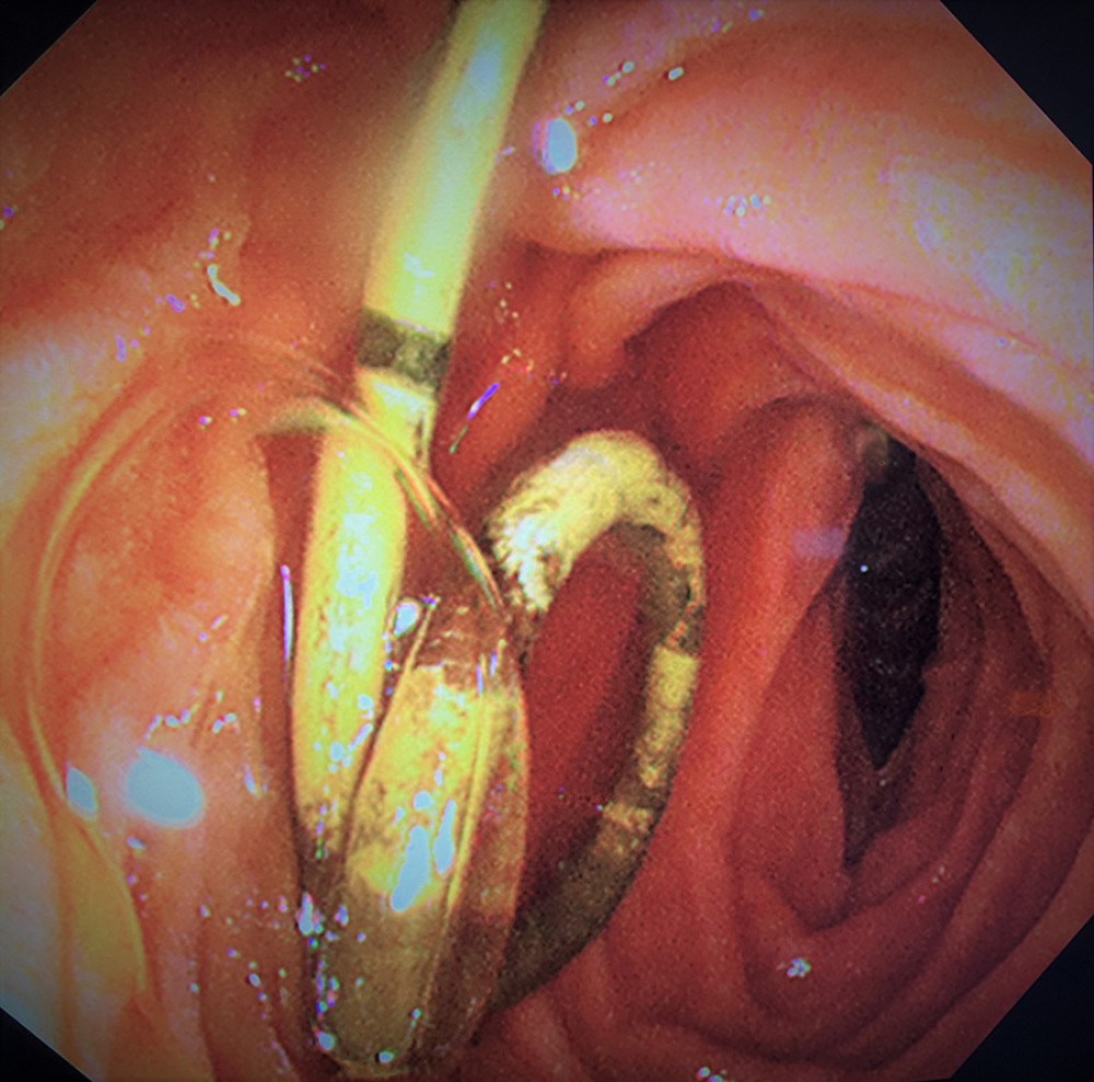 Intraoperative duodenoscopy with plastic pigtail stent exiting the papilla.