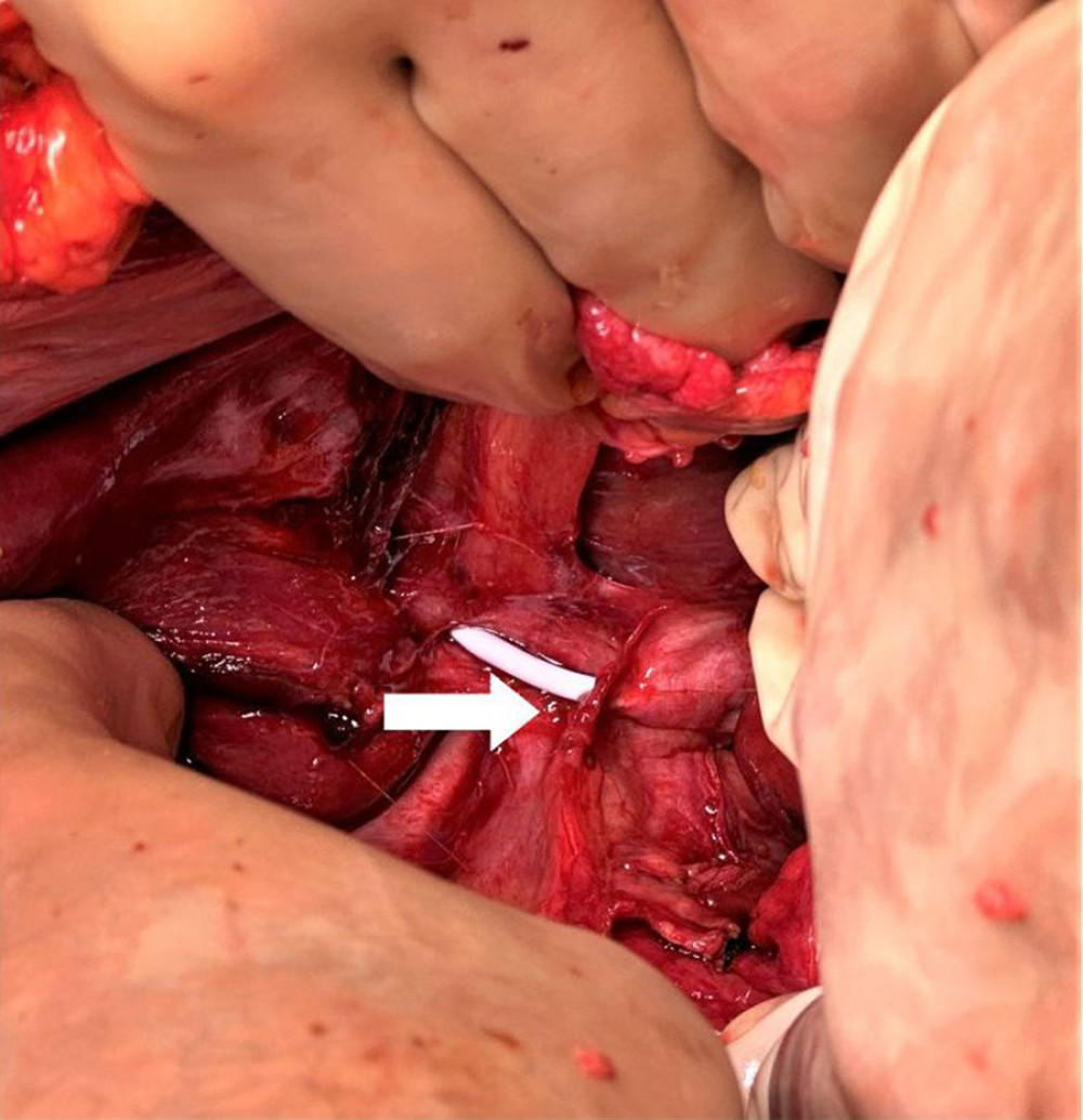 Intraoperative identification of the stent outside the left hepatic duct (white arrow).