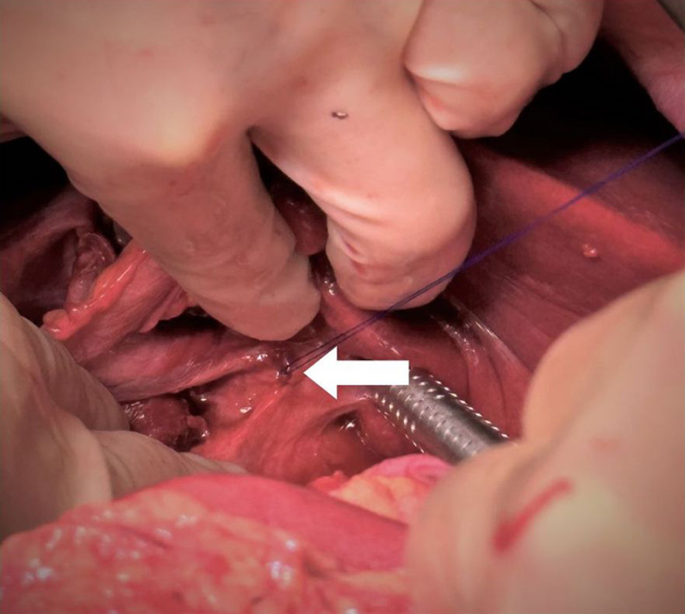 Closure of left hepatic duct perforation with 3-0 polypropylene figure-eight suture (black arrow).