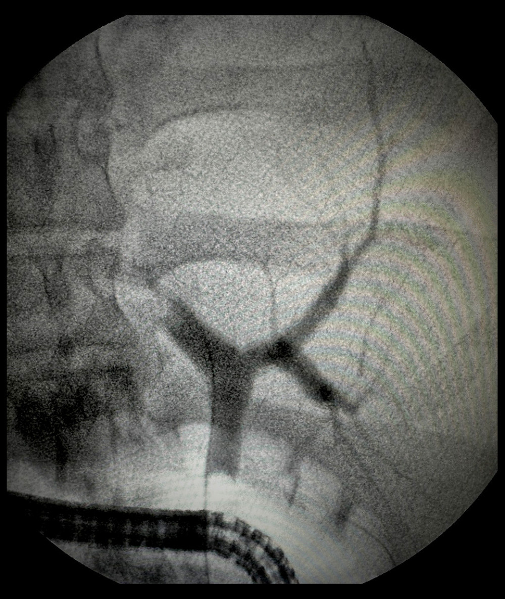Balloon-occluded endoscopic cholangiogram demonstrating no contrast extravasation or fistulous track.