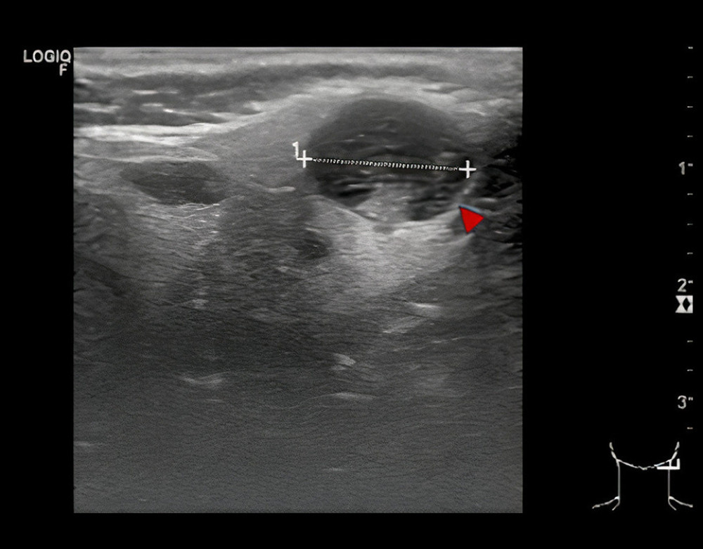 Presurgical imaging: An ultrasonographical examination revealed a smoothly circumscribed, homogeneous mass (1.4×1.2 cm, marked by an arrow).