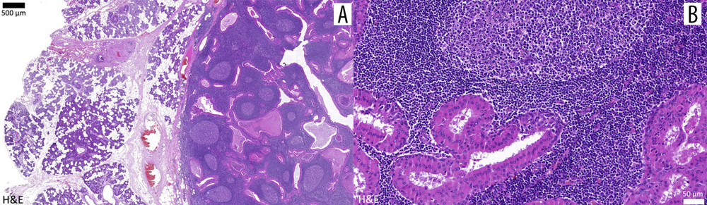 Postoperative histopathology: (A) Adjacent to the lipomatous, berry-shaped glandular fragments of the parotid gland, an encapsulated tumorous lesion was found. A lymphoid stroma with formed germinal centers and an epithelial tumor component are shown. (B) The tumor shows a (mostly) bilayered epithelium – partly cystic, partly solid – attached to a lymphoid stroma. In the upper center of the image, a germinal center is displayed (H&E – hematoxylin and eosin staining).