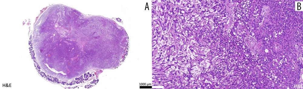 Postoperative histopathology: (A) Overview of the preauricular tumor showing a distinct capsule surrounded by acinar glands. (B) The lesion consists of predominant myoepithelial cells (right) adjacent to a myxoid stromal component (left) (H&E – hematoxylin and eosin staining).