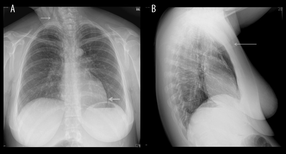 Chest X-ray in postpartum pneumomediastinum: Hamman’s syndrome. Frontal (A) and lateral (B) radiographs showing vertical lucent stripes into neck and along the chest wall (thin arrows) and lucency surrounding the heart (thick arrow) corresponding to subcutaneous emphysema and pneumomediastinum.