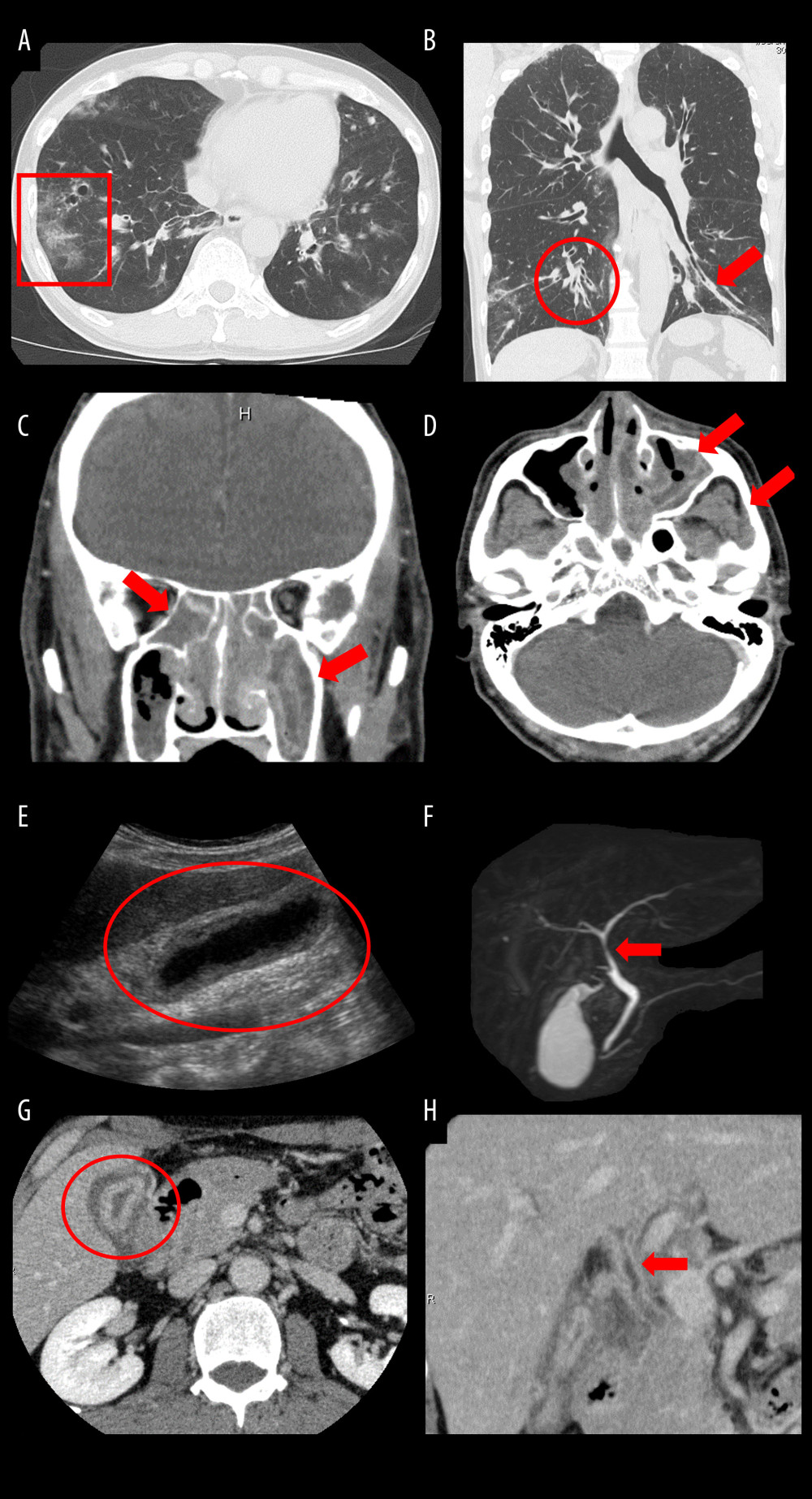 Radiological findings of major organ lesions. (A, B) Computed tomography (CT) scan of the chest showing predominant ground-glass opacities in the peripheral lower lobe of the right lung (square), bronchial wall thickening in the lower lobe (circle), and mucus plugs (arrow). (C, D) CT scan of the paranasal sinuses showing soft tissue densities and mucosal thickening of the nasal mucosa, predominantly in the left maxillary sinus (arrow). (E) Abdominal ultrasonogram showing circumferential thickening of the medial layer of the gallbladder wall (circle). (F) Magnetic resonance cholangiopancreatography scan showing stenosis of the common hepatic duct (arrow). (G, H) Abdominal contrast-enhanced CT scan showing diffuse wall thickening with subserosal edema that can be seen consecutively throughout the gallbladder, cystic duct, left and right hepatic ducts, and common bile duct (circle and arrow).