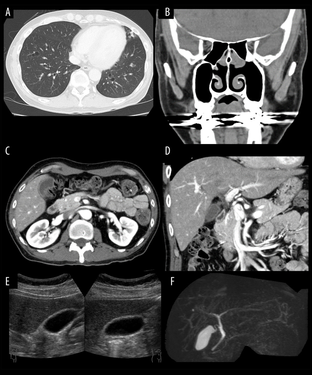 Repeat imaging of the previously lesioned organs. (A) Computed tomography (CT) scan of the chest showing the absence of ground-glass opacities and the reduction in bronchial wall thickening. (B) CT scan of the paranasal sinuses showing a reduction in mucus filling and of the thickening of the mucosa. (C–E) Contrast-enhanced CT scan of the abdomen and ultrasonogram showing reduction of the wall thickening in the gallbladder and bile duct. (F) Magnetic resonance cholangiopancreatography scan showing disappearance of the stenosis of the common hepatic duct.