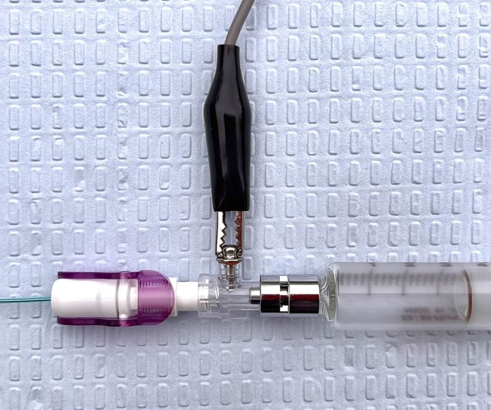 Epidural catheter connected to Johan adapter with attached nerve stimulator cathode and sterile syringe filled with normal saline.