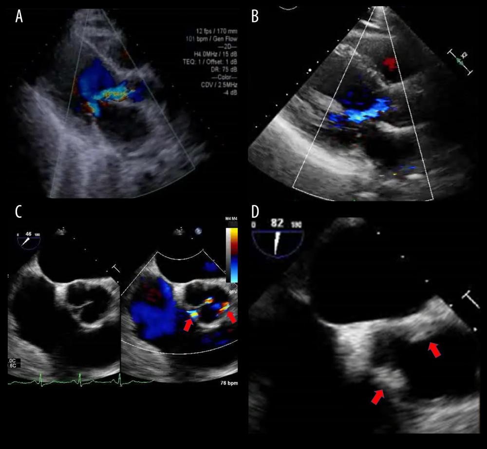 (A) Echocardiography showed moderate or severe aortic regurgitation at the time of the patient’s admission. (B) Two months later, echocardiography showed that the patient’s left ventricular ejection fraction had improved to 37% and aortic regurgitation had improved from moderate to mild status. (C) Transesophageal echocardiography revealed that the patient’s aortic regurgitation was stronger at the gap between the coronary cusp and the aorta rather than at the apex of the valve (arrow). (D) Aortic wall lesions similar to those seen on computed tomography were also observed on transesophageal echocardiography (arrow).
