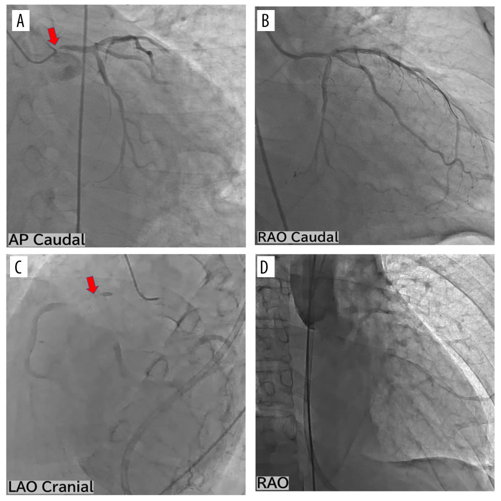 (A) Coronary angiography revealed 99% stenosis in the left coronary artery (LCA) at the ostium of the left main coronary artery (LMT) (arrow). (B) Final contrast enhancement showed good stent dilation and no residual stenosis in the LCA. (C) Coronary angiography 1 week after the percutaneous coronary intervention of the patient’s LCA confirmed a collateral blood channel from the LCA to the right coronary artery, which was occluded at the ostium (arrow). (D) Aortography showed degree II aortic regurgitation.