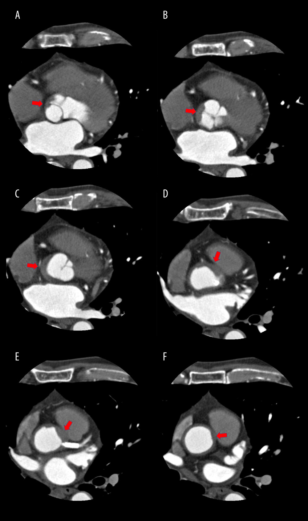 (A–F) A cardiac computed tomography scan series revealed a plaque-like aortic mural lesion in the ascending aorta near the beginning of the coronary artery (arrow).