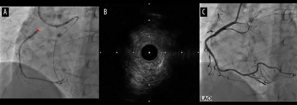 (A) The main stem of the right coronary artery (RCA) is contrasted with a retrograde approach from the left coronary artery (LCA). (B) On intravascular ultrasound in the position of the line, the lesion appeared to be a series of relatively low-intensity plaques. (C) Final contrast enhancement of the right coronary artery showed no residual stenosis, including in the stent.