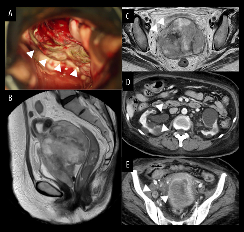 (A) A bulky mass at the cervix with a bad odor was observed per vaginal speculum examination. Sagittal (B) and axial (C) magnetic resonance imaging (MRI) showed a mass lesion measuring 12.1×8.9 cm in size in the uterine cervix with infiltration into the parametrium (C). A computed tomography (CT) scan showing right hydronephrosis (D) and pelvic lymphadenopathy (E).