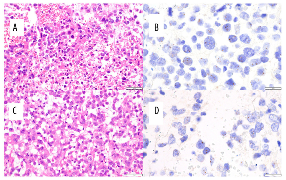 (A, B) Uterine cervical biopsy micrographs. Most of the lesions were necrotic tissues and inflammatory exudates, with a few atypical cell clusters with large, round nuclei. The lesions were positive for high-risk human papillomavirus (HR-HPV), which encompasses HPV strains 16, 18, 31, 33, 35, 39, 45, 51, 52, 56, 58, 59, and 68. (A) Hematoxylin and eosin (H&E) 40× objective. (B) HR-HPV in situ hybridization, 100× objective. (C, D) Subcutaneous biopsy micrographs. The histology was similar to that from the uterine cervix, with positive results for HR-HPV. (C) H&E 40X objective. (D) HR-HPV in situ hybridization, 100× objective.