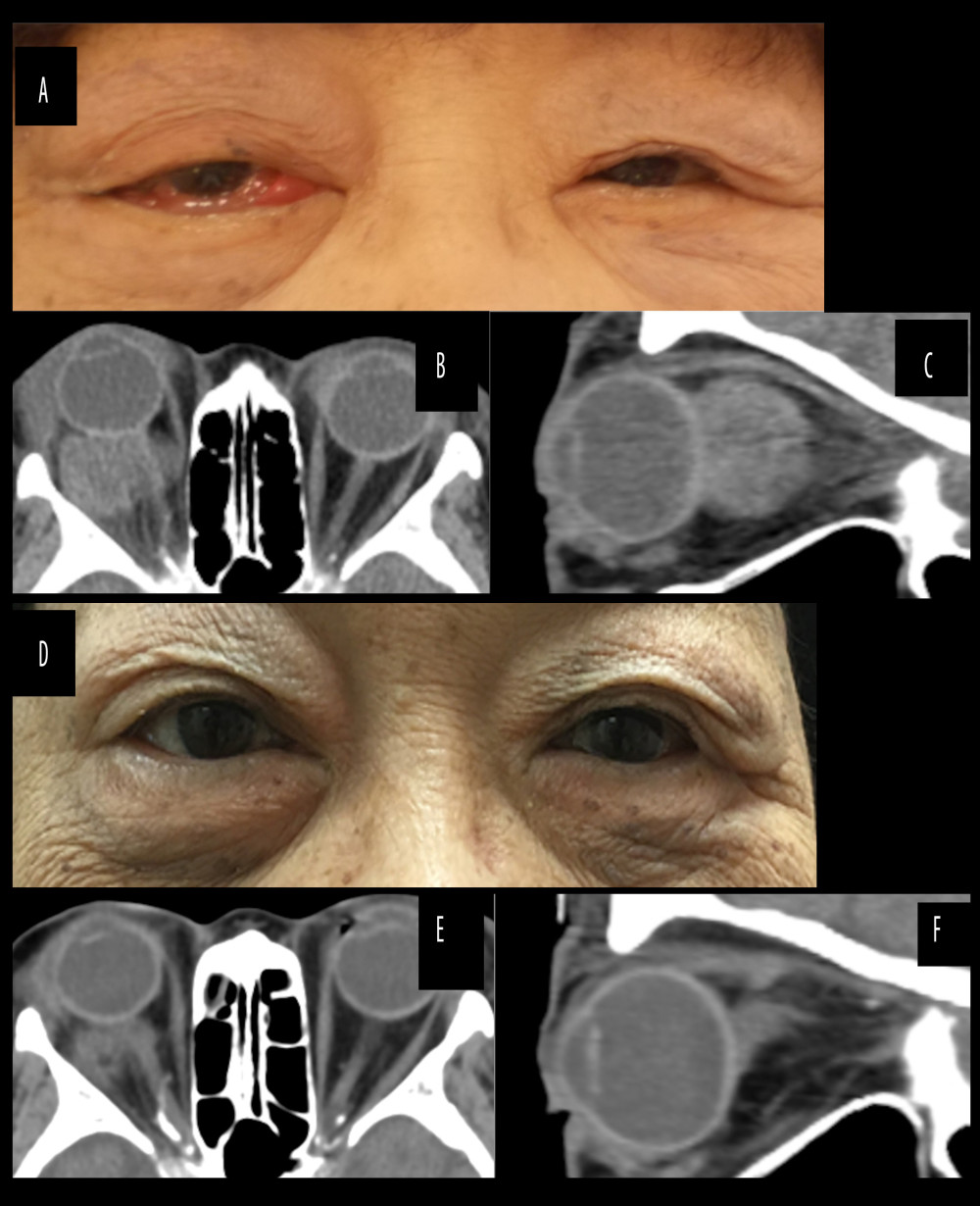 (A) Face photograph of the patient showing right exophthalmos. Axial (B) and sagittal (C) computed tomography (CT) showing a 3.1-cm diameter mass in the right orbit. (D) Face photograph showing regression of the right exophthalmos 124 days after radiation therapy. Axial (E) and sagittal (F) CT showing shrinkage of the orbital tumor.