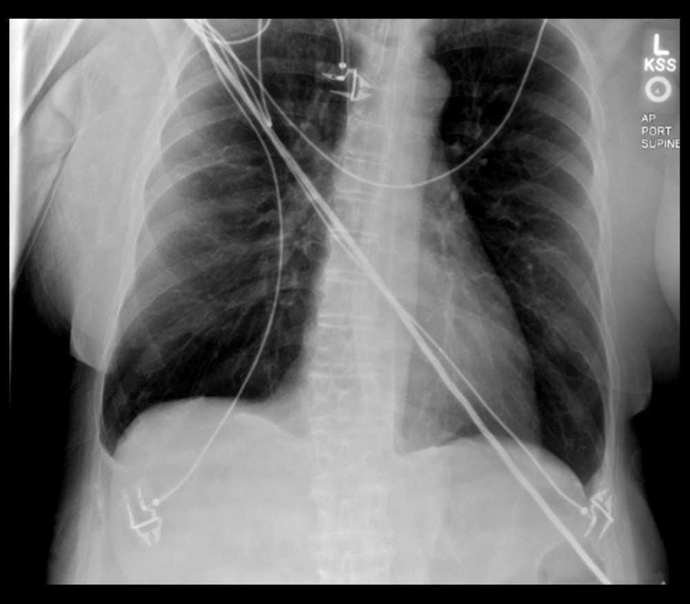Anteroposterior portable chest X-ray on admission, with no infiltrates identified.