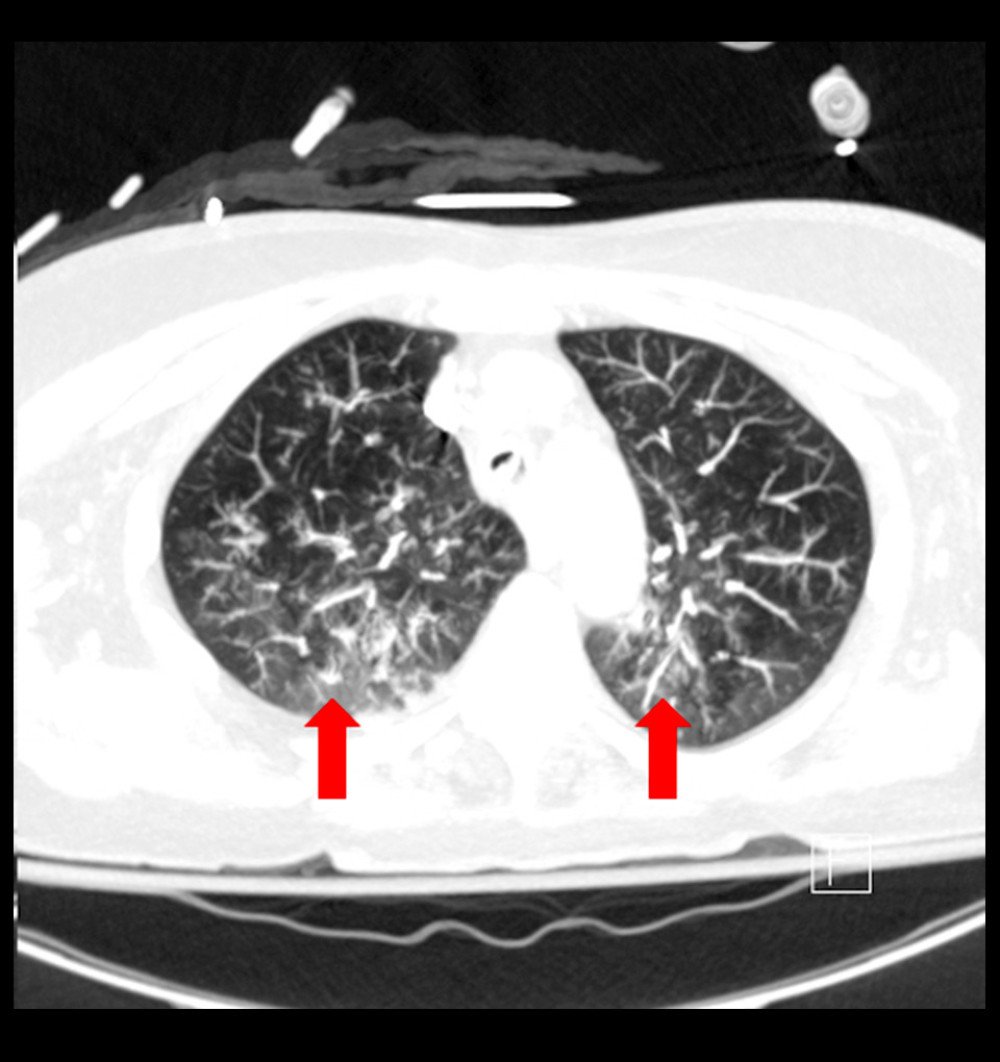 Computed tomography (CT) scan on admission with red arrows showing areas with evidence of multifocal pneumonia.