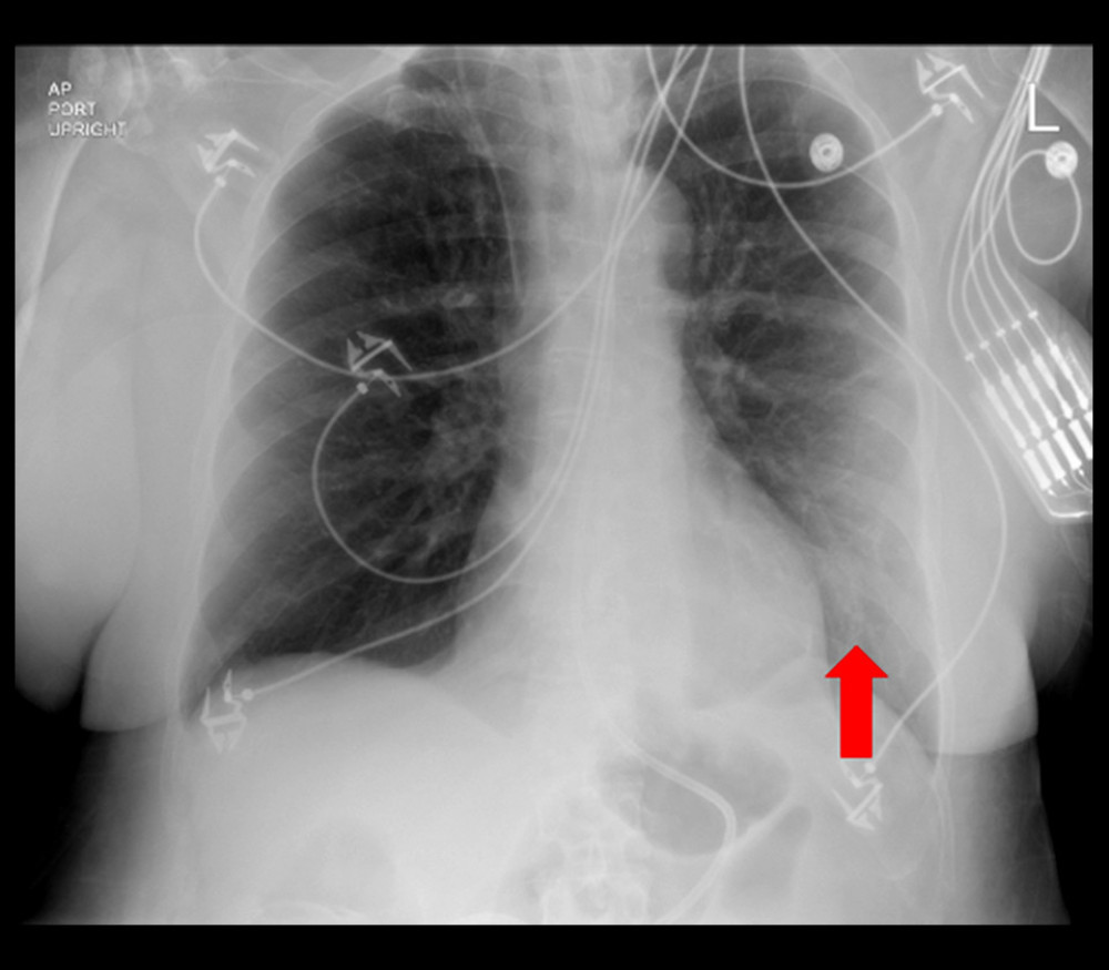 Anteroposterior portable chest X-ray on hospital day 7 with red arrow showing area of new infiltrate in the left lower lobe.