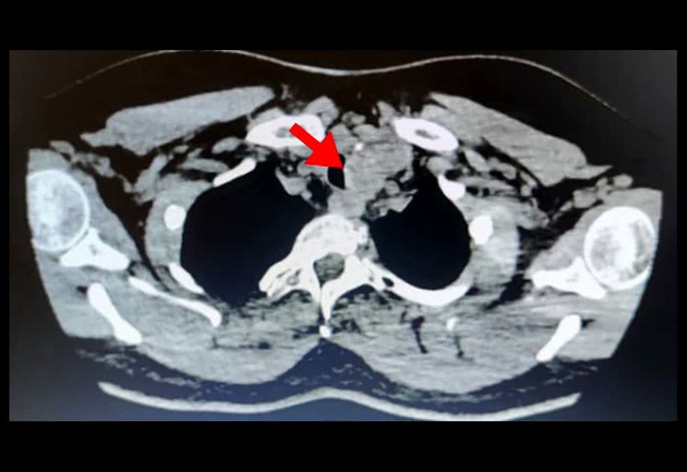 High-resolution computed tomography showing enlarged left thyroid with tracheal compression (red arrow).