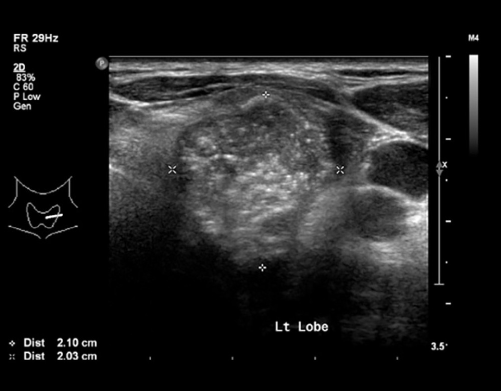 Ultrasound of thyroid showing left thyroid nodule TR 5.