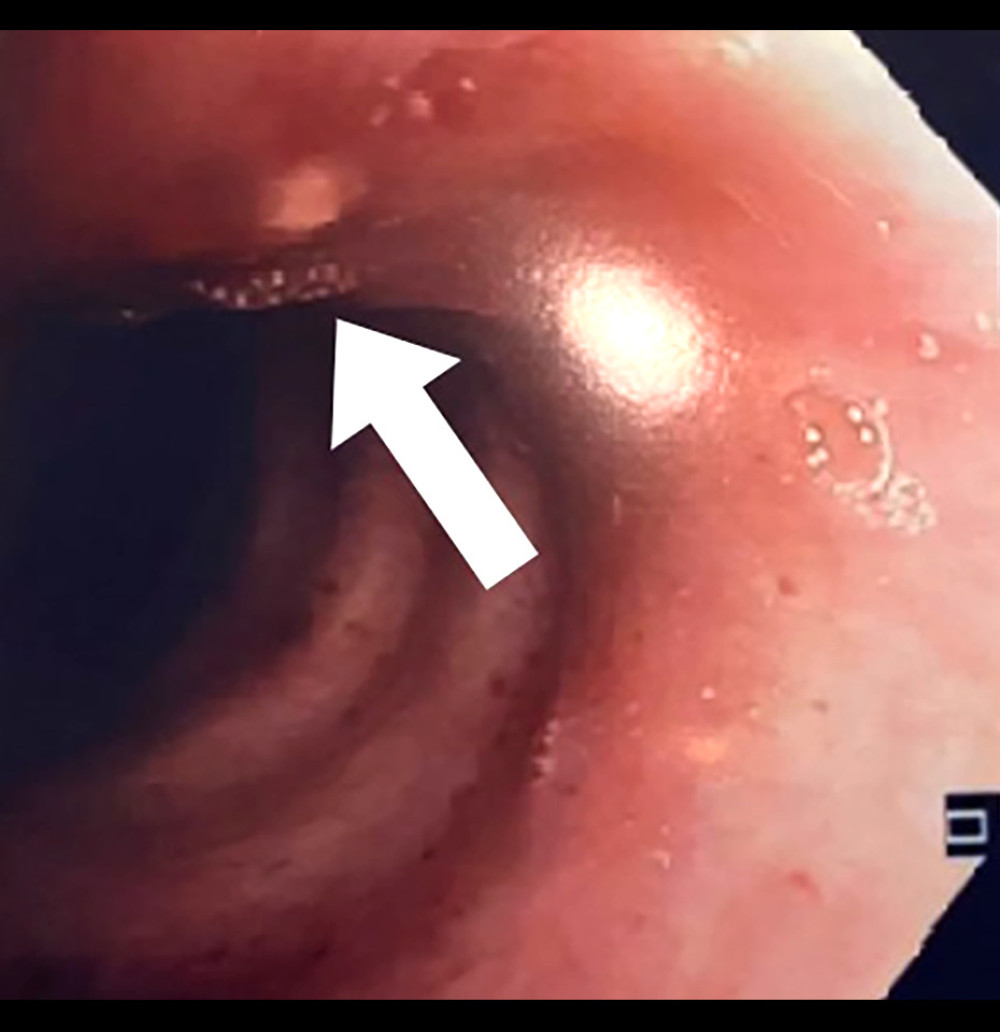 Bronchoscopy image showing the area of external tracheal compression with multiple tiny ulcers (white arrow).