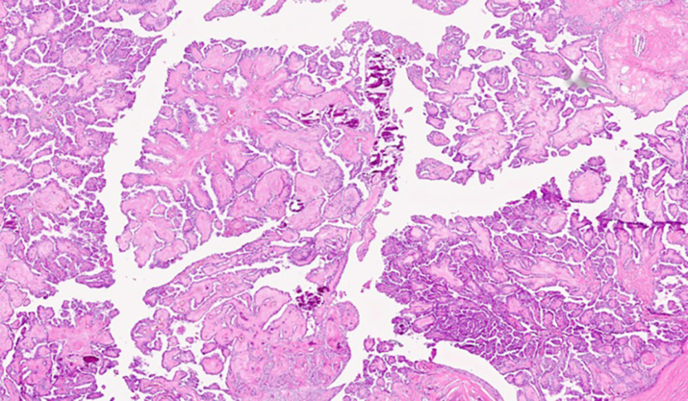 The photomicrograph of the thyroid tumor shows malignant papillary structures with dense sclerotic cores and scattered calcification (hematoxylin and eosin stain, 40× magnification).