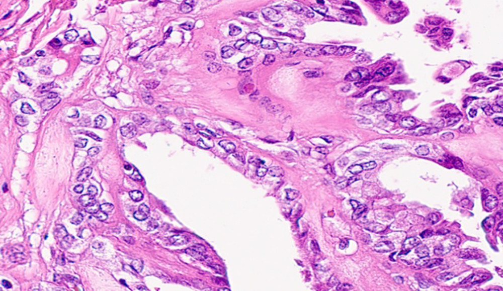 The photomicrograph shows the malignant cells exhibit nuclear changes such as crowding, clearing, grooving and occasional pseudoinclusions (hematoxylin and eosin stain, 400× magnification).