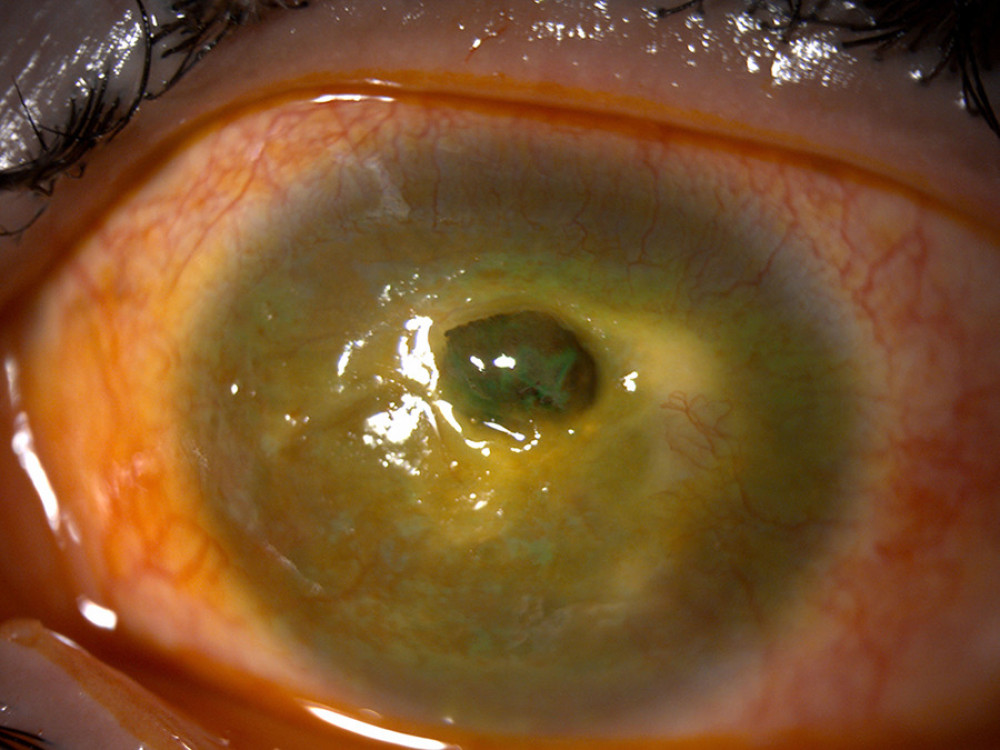 Central corneal perforation with iris prolapse and collapsed anterior chamber.