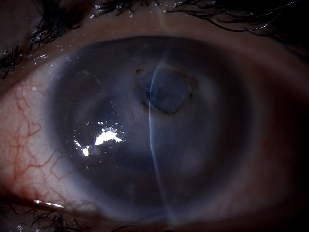 A stable anterior chamber and a sealed corneal wound after a surgical intervention using a mini-Descemet’s automated endothelial keratoplasty (DSAEK) tissue, amniotic membrane, and fibrin glue.