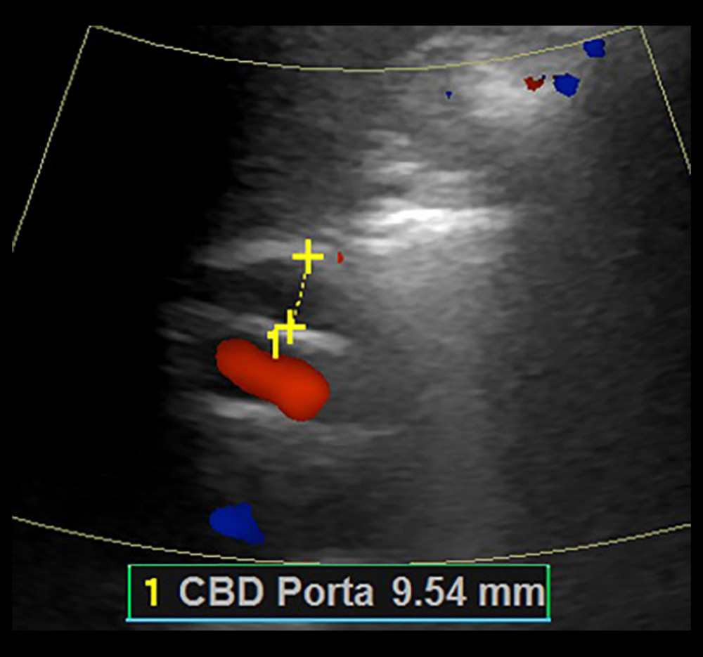 Ultrasound abdomen showing mild common bile duct (CBD) dilation of 9.5 mm (first admission).