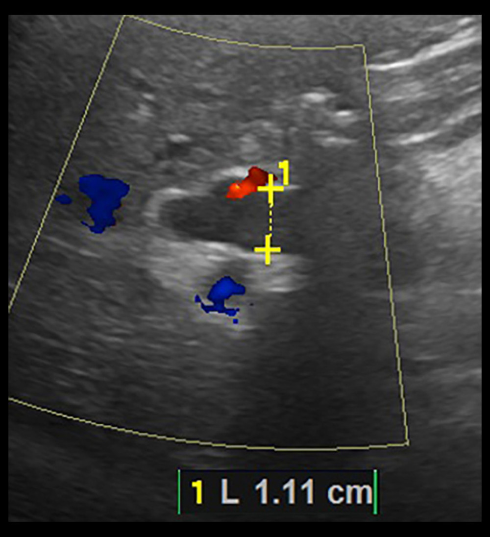 Ultrasound abdomen showing more pronounced common bile duct (CBD) dilation of 11.5 mm (second admission).