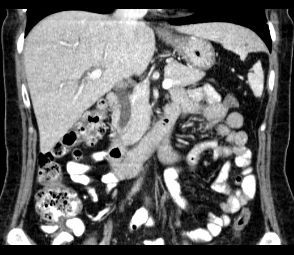 Computed tomography (CT) scan abdomen and pelvis with contrast, coronal view, demonstrating 2 cm CBD dilation.