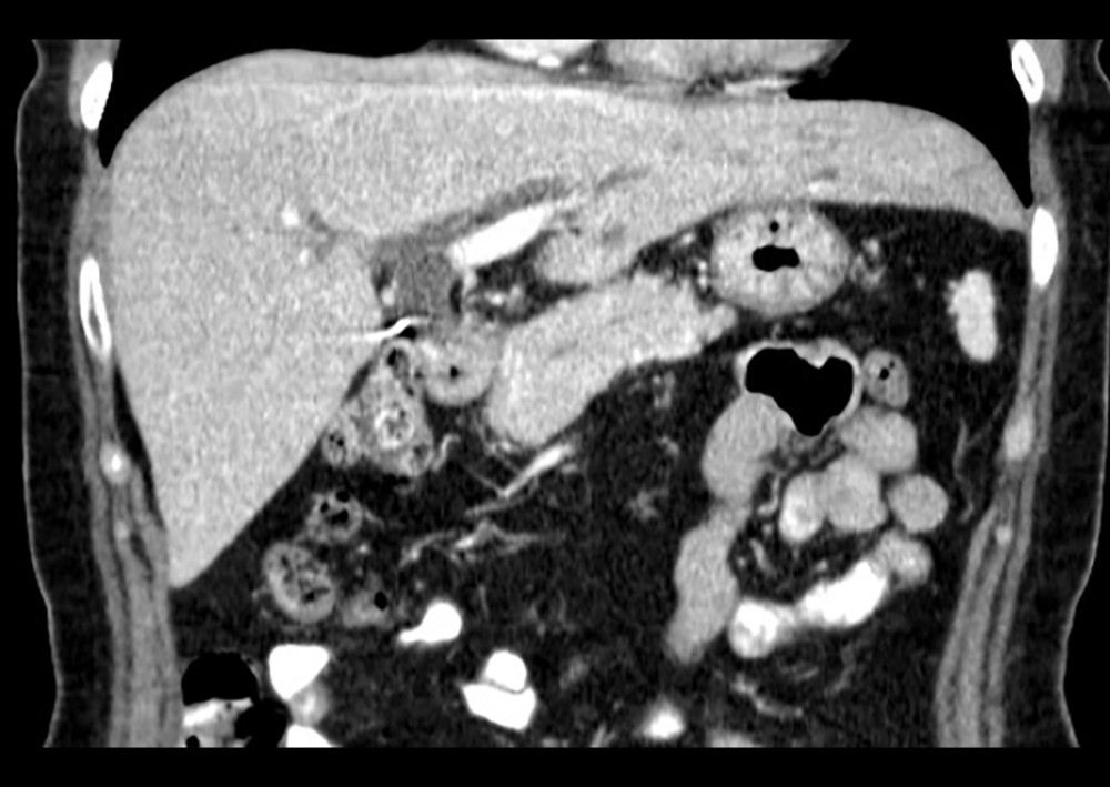 CT scan of the abdomen and pelvis w/contrast, coronal view, demonstrating moderate intrahepatic biliary dilation.
