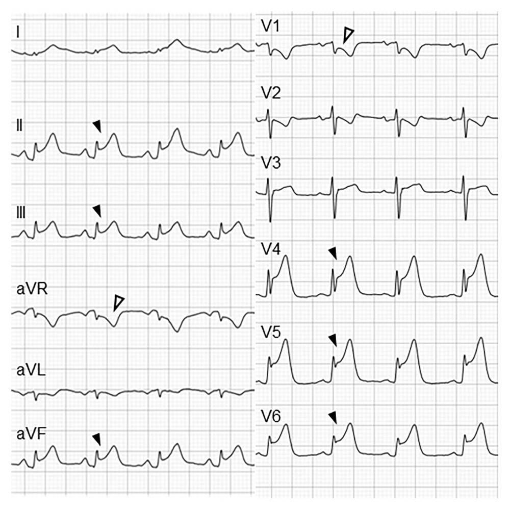 Electrocardiography findings on arrival. Electrocardiography reveals ST elevation in II, III, aVF, and V4–6 (black arrowheads) and ST depression in aVR and V1 (white arrowheads) without any reciprocal changes, which are not specific ST changes for ischemic heart diseases.