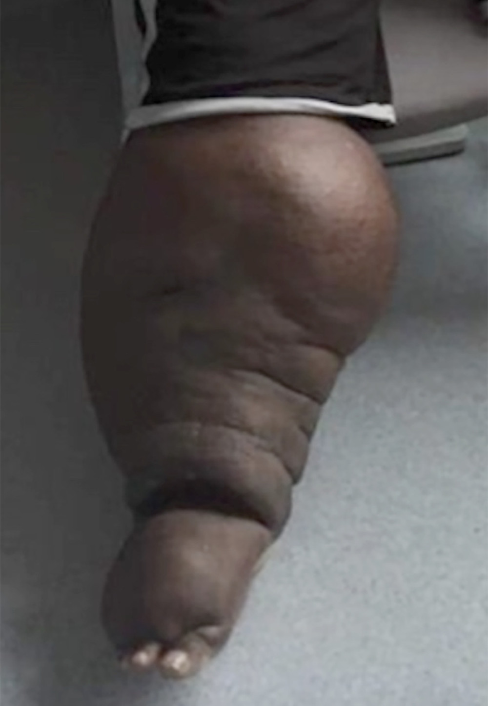 Picture of elephantiasis in the right lower limb of the patient.