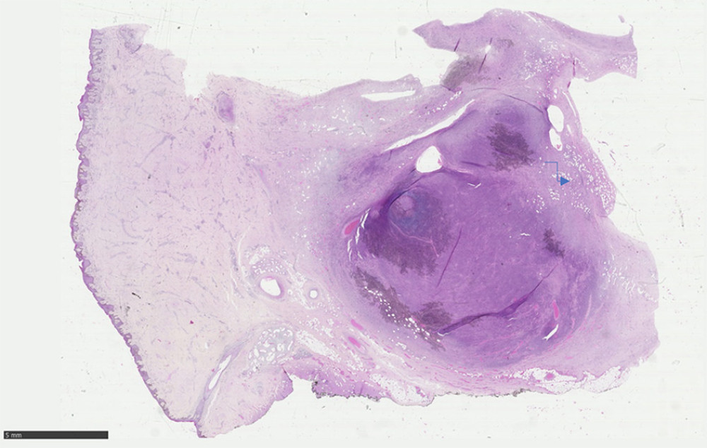 Low-power view (×0.5) demonstrating a diffuse partially nodular infiltration of the deep dermis and subcutis. Note that the epidermis is spared. Arrows showing the typical honeycomb appearance of the infiltration of the subcutis.