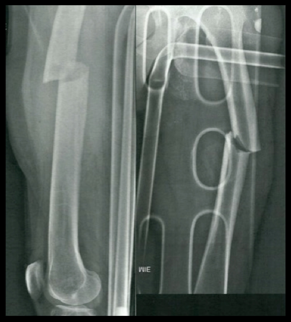 Radiographic lateral and frontal views of the atypical fracture of the left femur, showing diffuse thickening of both diaphyseal cortices.