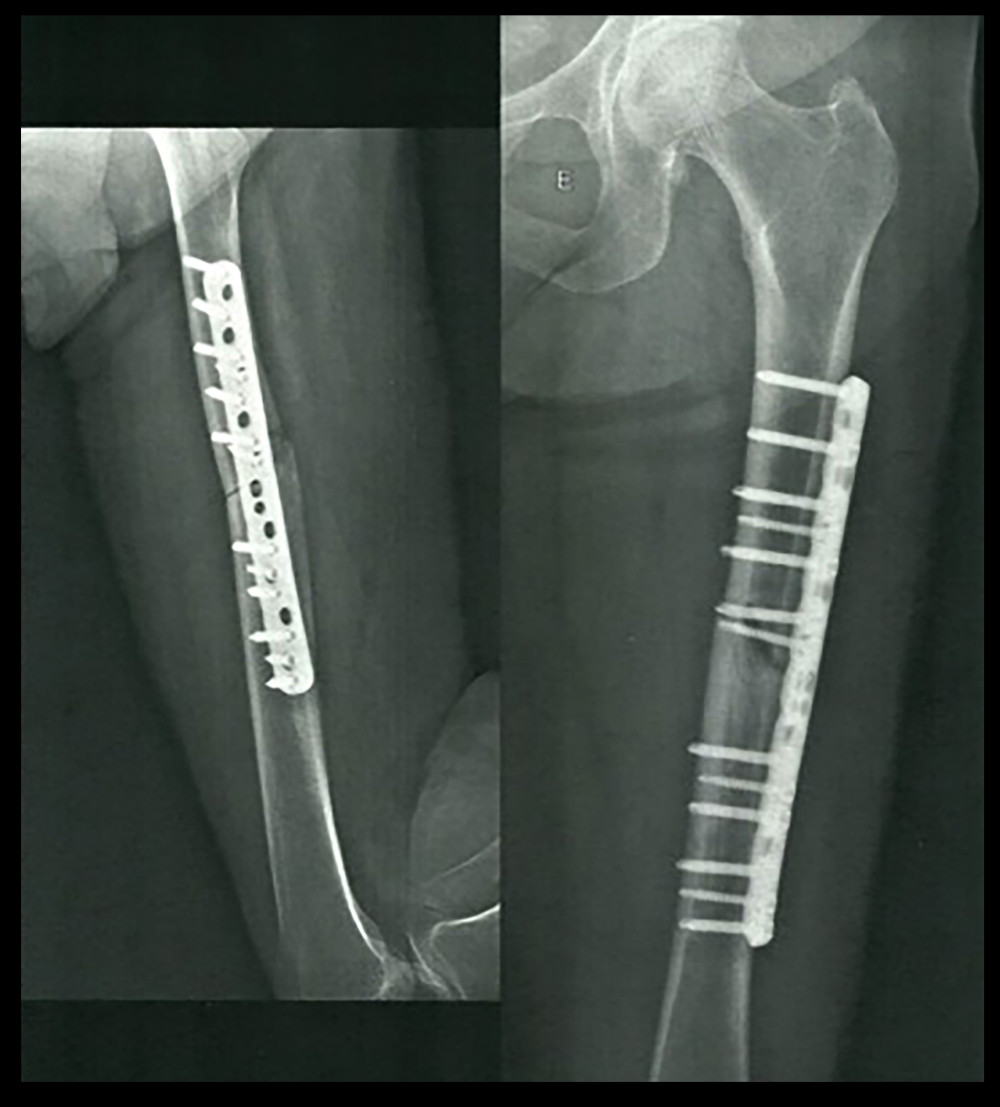Radiographic lateral and frontal views of the femoral fracture’s internal fixation.