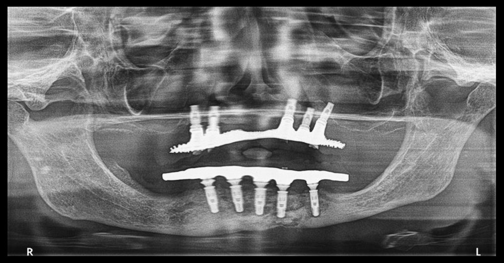 Panoramic radiograph before the pathologic mandibular fracture with osteonecrosis extending to the base of the mandible.