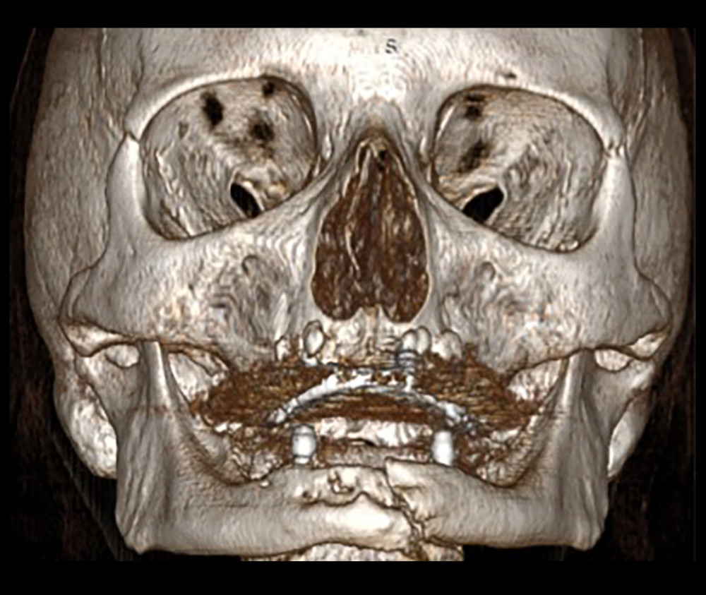 Three-dimensional computed tomography scan’s frontal view of the pathologic mandibular fracture secondary to medication-related osteonecrosis of the jaws.