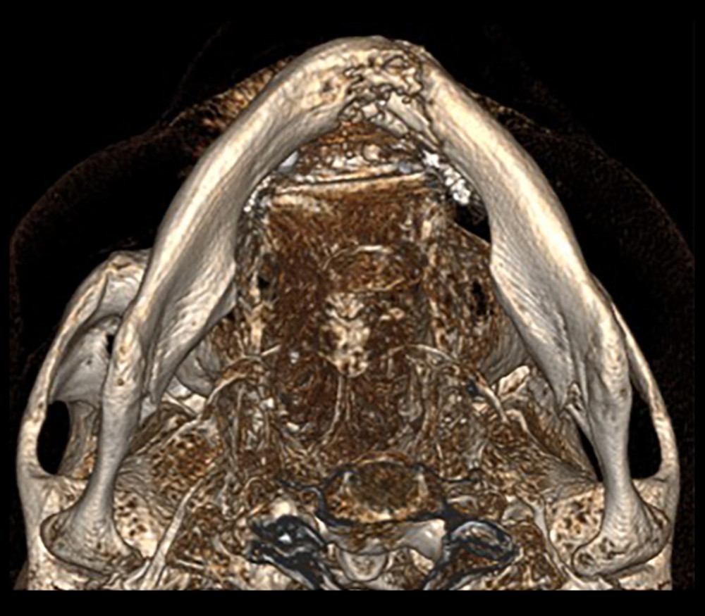 Three-dimensional computed tomography scan’s inferior view of the pathologic mandibular fracture secondary to medication-related osteonecrosis of the jaws.