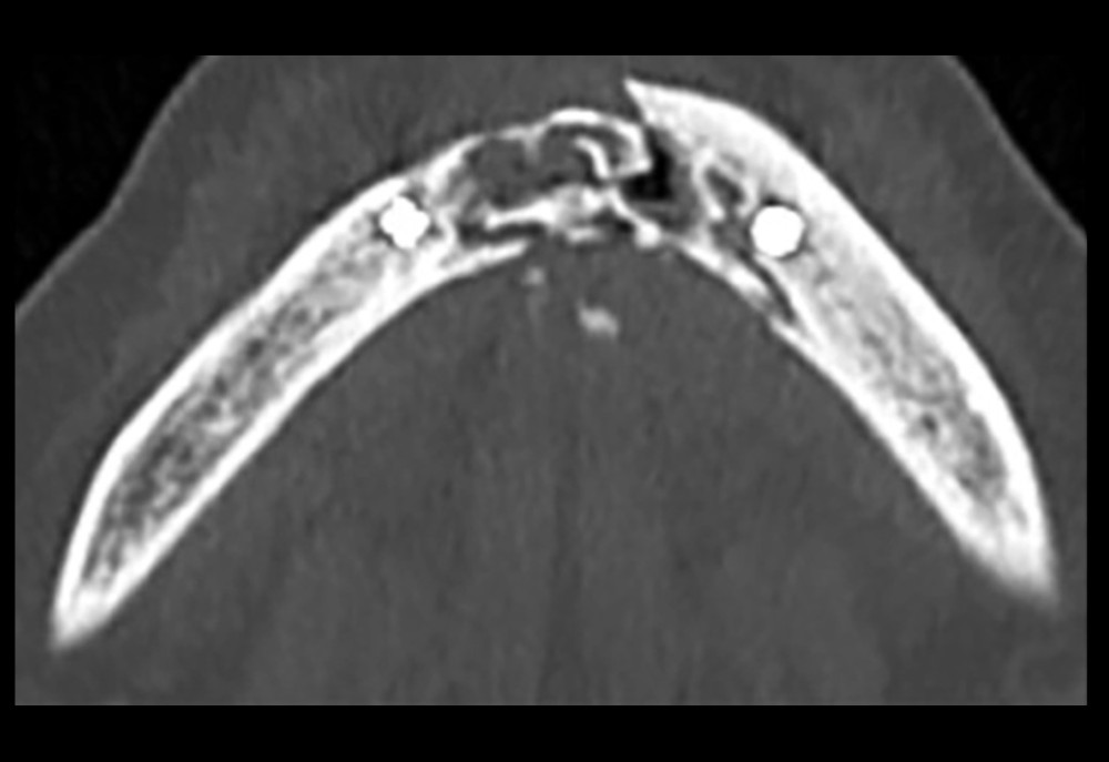 Computed tomography scan’s axial view of the osteonecrosis site and pathologic mandibular fracture.