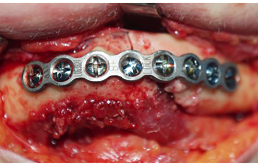 Intraoperative view of the mandibular fracture’s internal fixation.